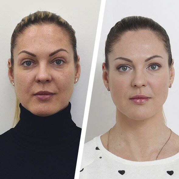 Rajeunissement du visage sans chirurgie avant et après