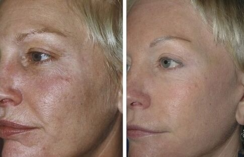 Rajeunissement fractionné de la peau au laser avant et après photos
