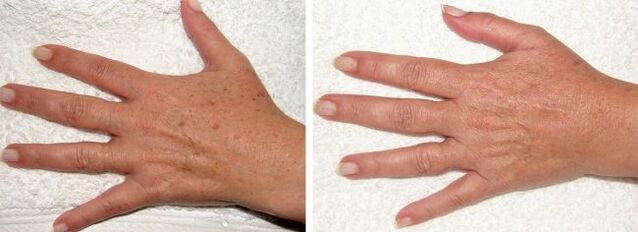 L'effet de l'élimination des taches pigmentaires sur les mains