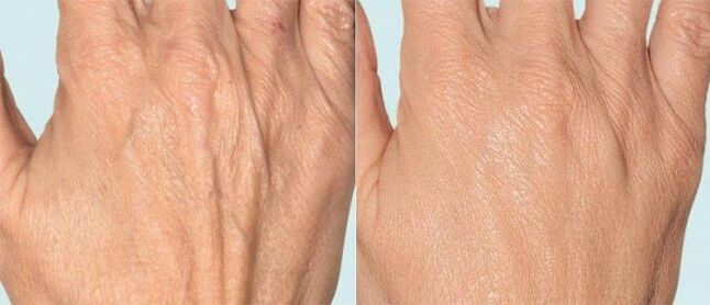 Peau des mains avant et après traitement segmentaire