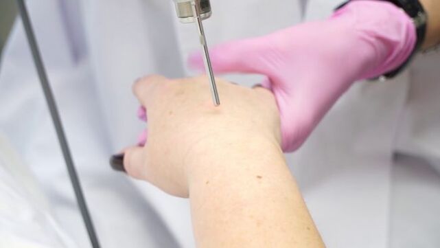 Rajeunissement des mains au laser