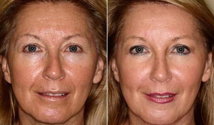 Avant et après le rajeunissement du visage à la maison