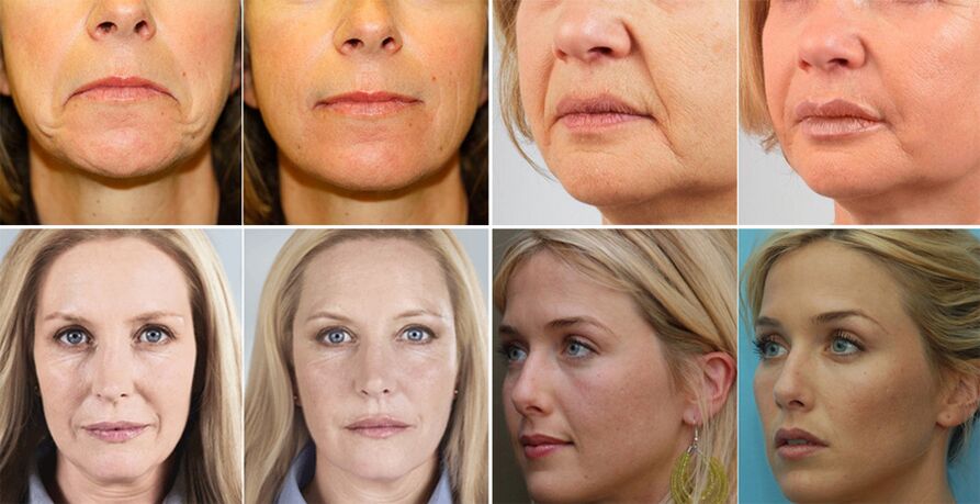 Photos de femmes avant et après le rajeunissement du visage