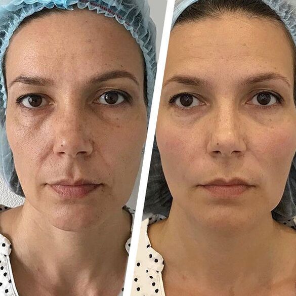 Photos du visage avant et après le rajeunissement laser